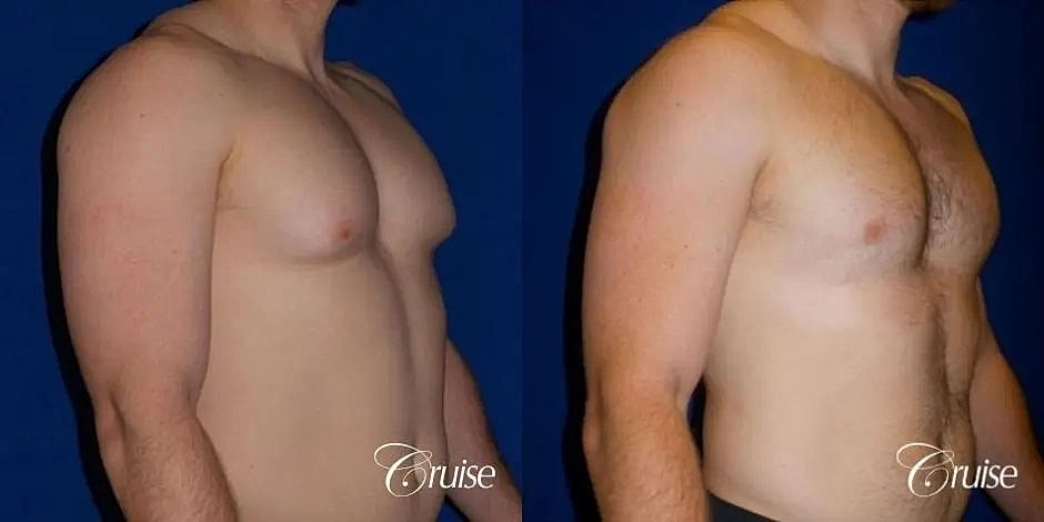 Gynecomastia Surgery Before & After
