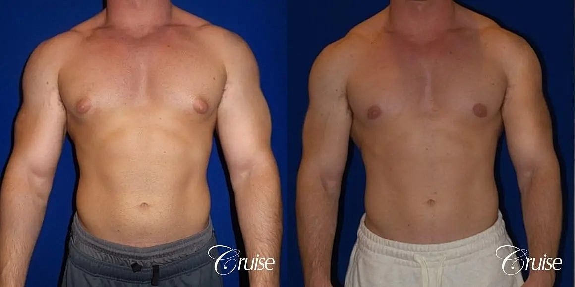 Gynecomastia Surgery Before & After