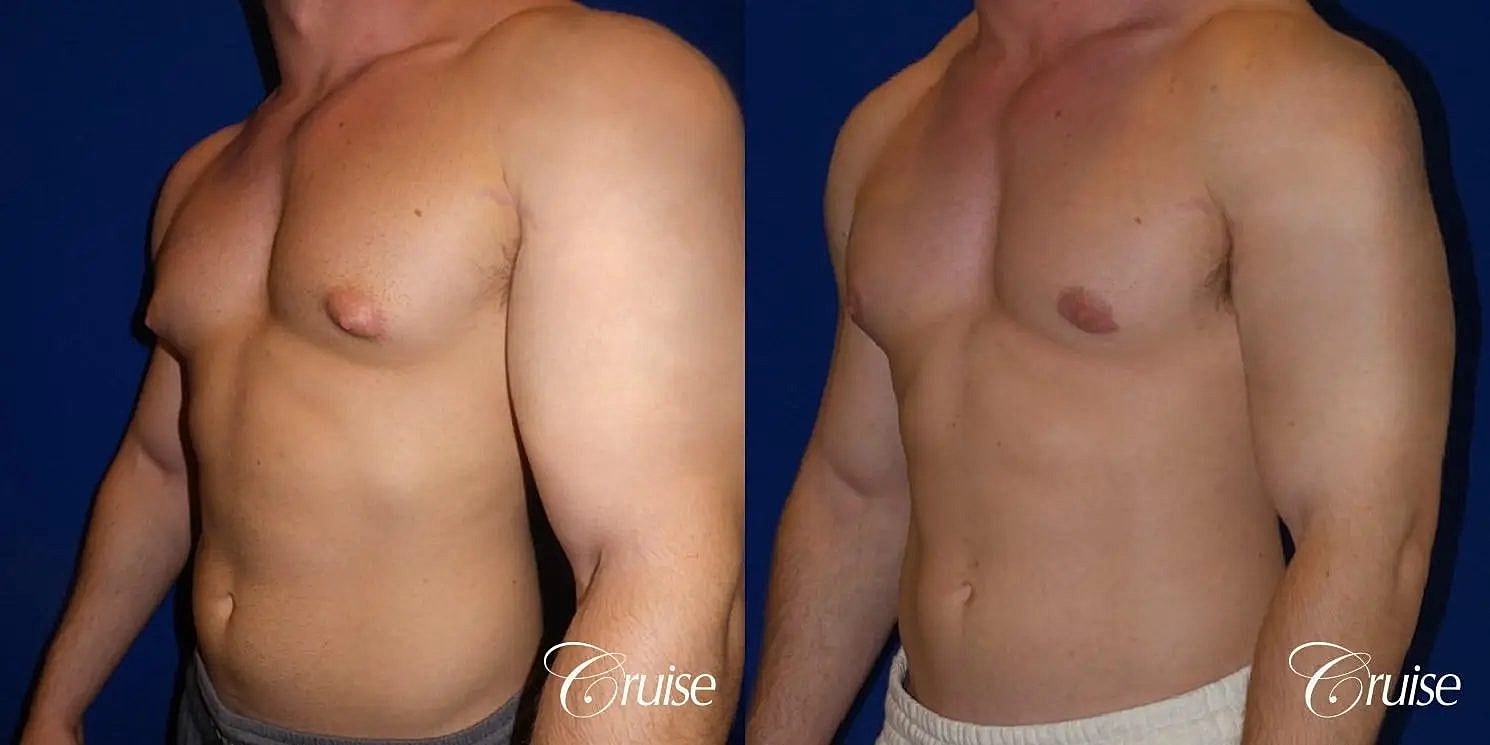 Gynecomastia Surgery Before & After