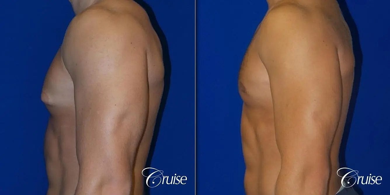 Gynecomastia Surgery Before & After