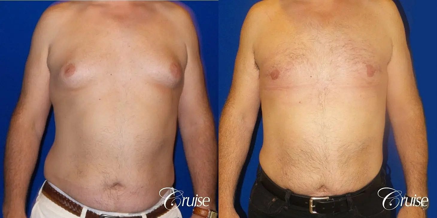 Gynecomastia Surgery Before & After