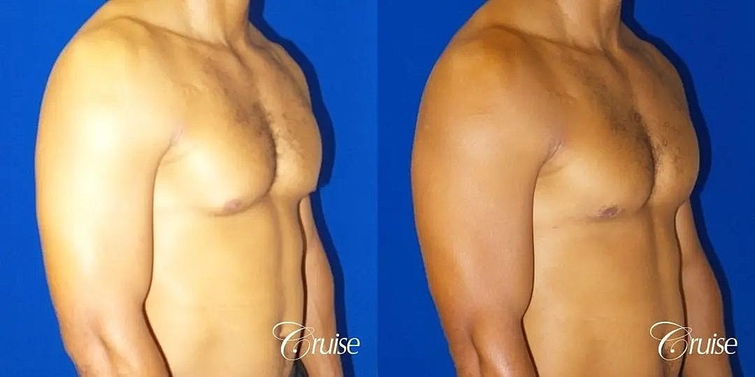 Gynecomastia Surgery Before & After