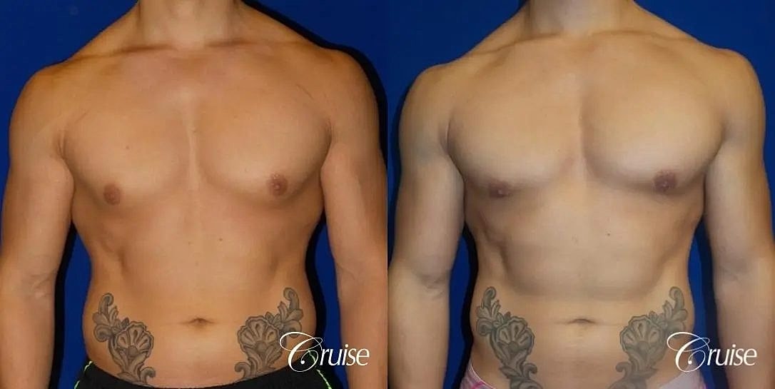 Gynecomastia Surgery Before & After