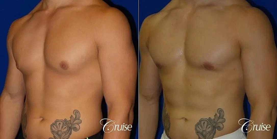 Gynecomastia Surgery Before & After