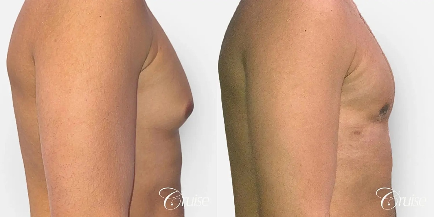 Gynecomastia Surgery Before & After