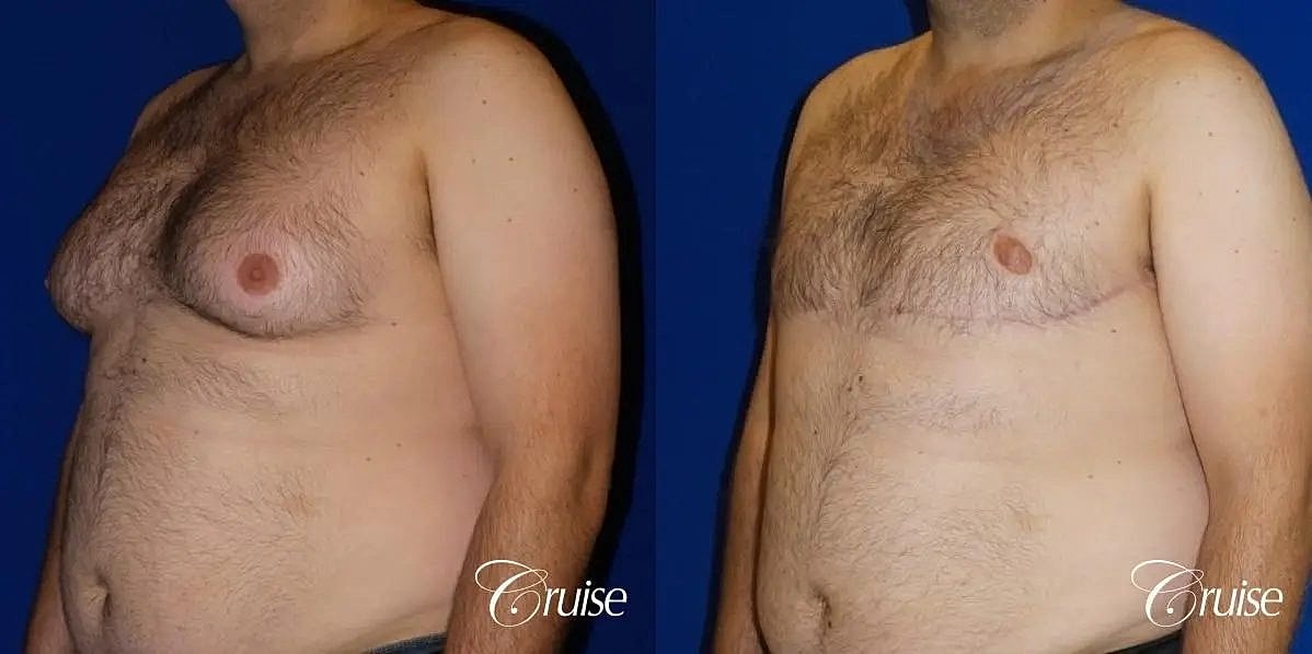 Gynecomastia Surgery Before & After