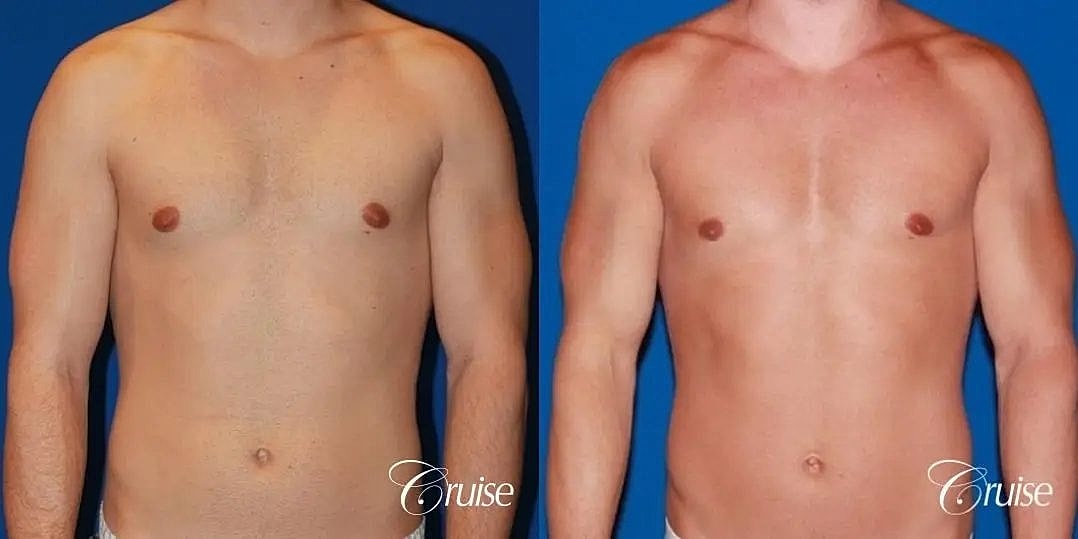 Gynecomastia Surgery Before & After