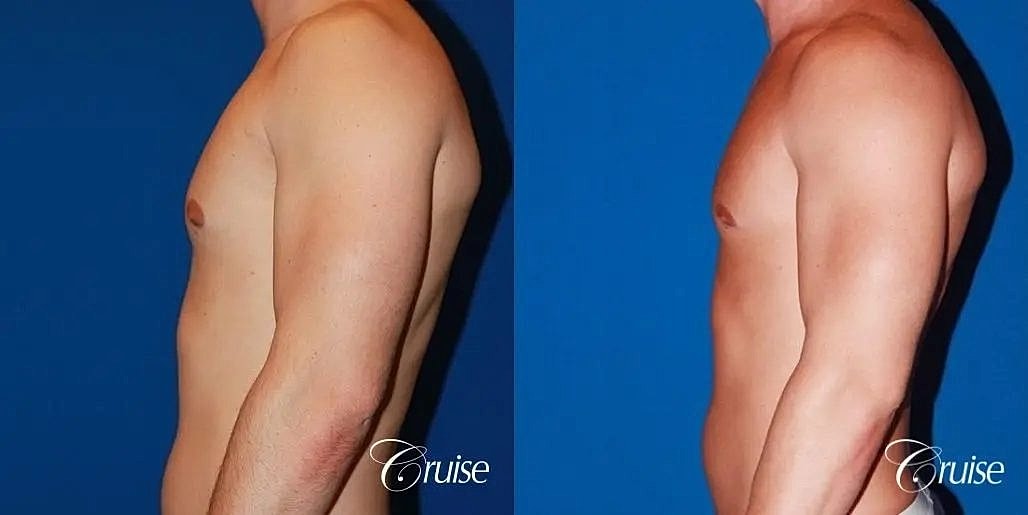 Gynecomastia Surgery Before & After