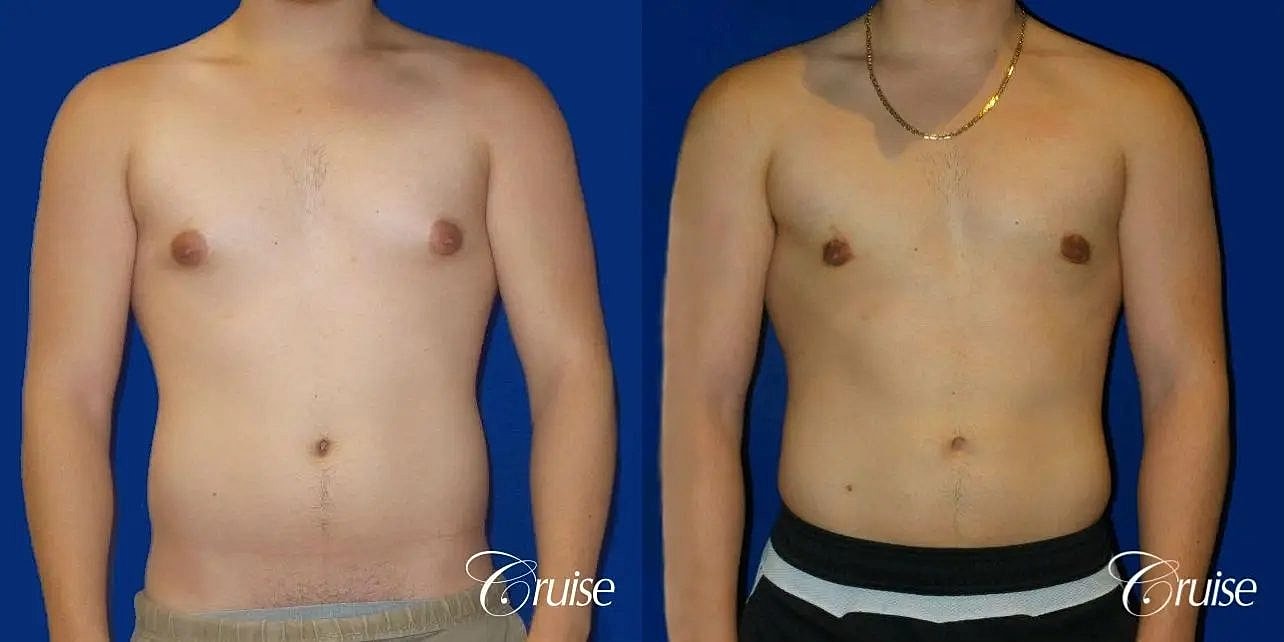 Gynecomastia Surgery Before & After