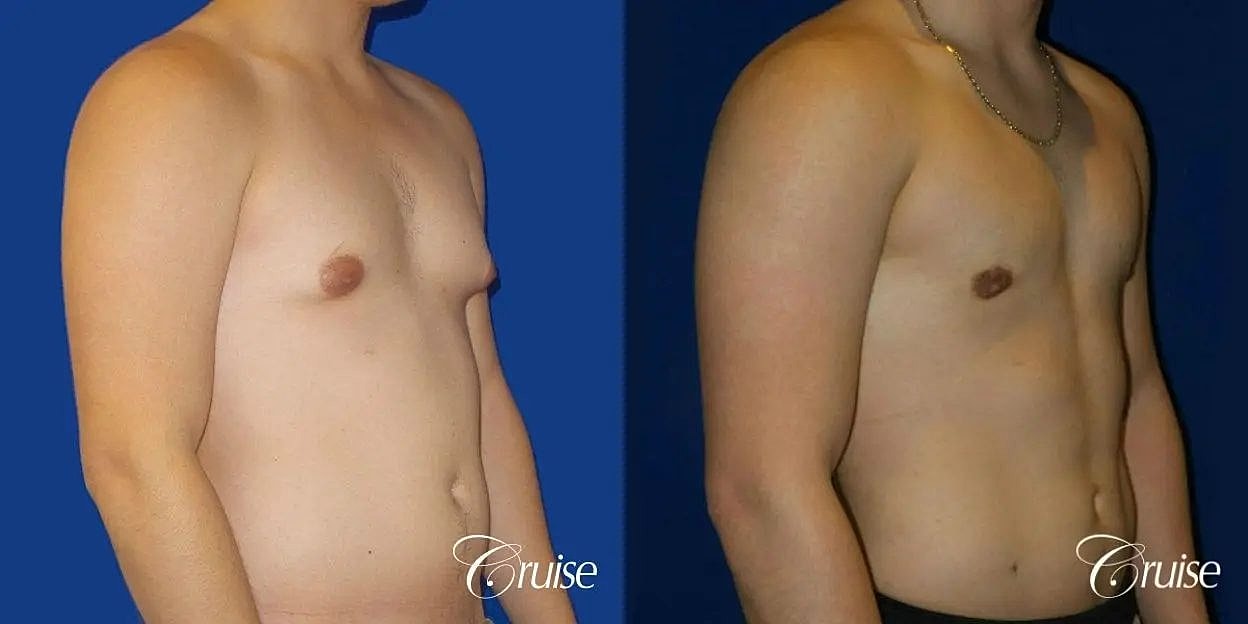 Gynecomastia Surgery Before & After
