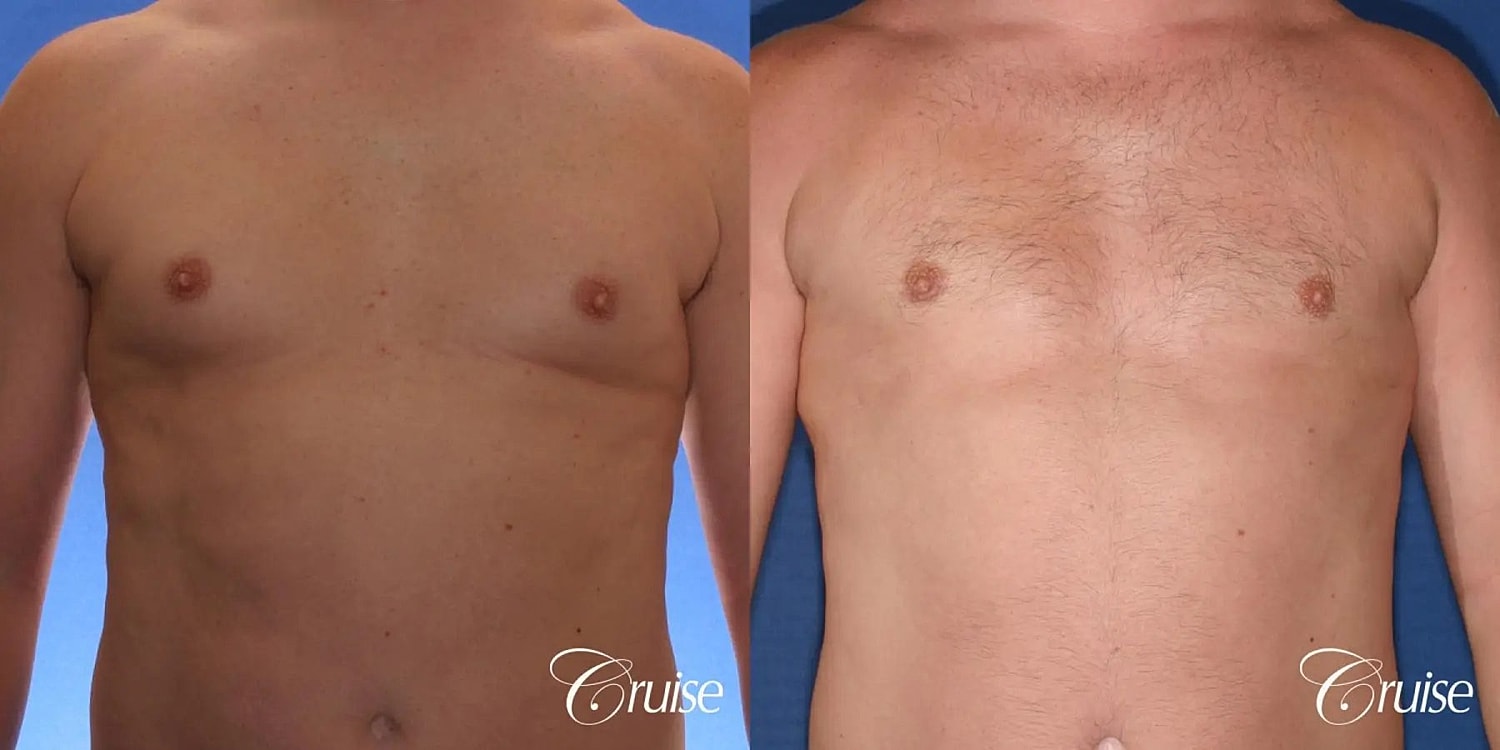 Gynecomastia Surgery Before & After