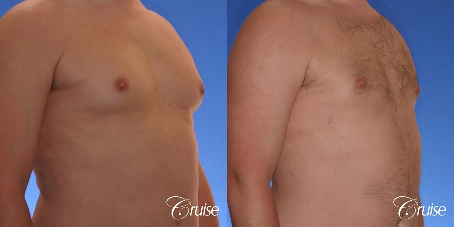 Gynecomastia Surgery Before & After