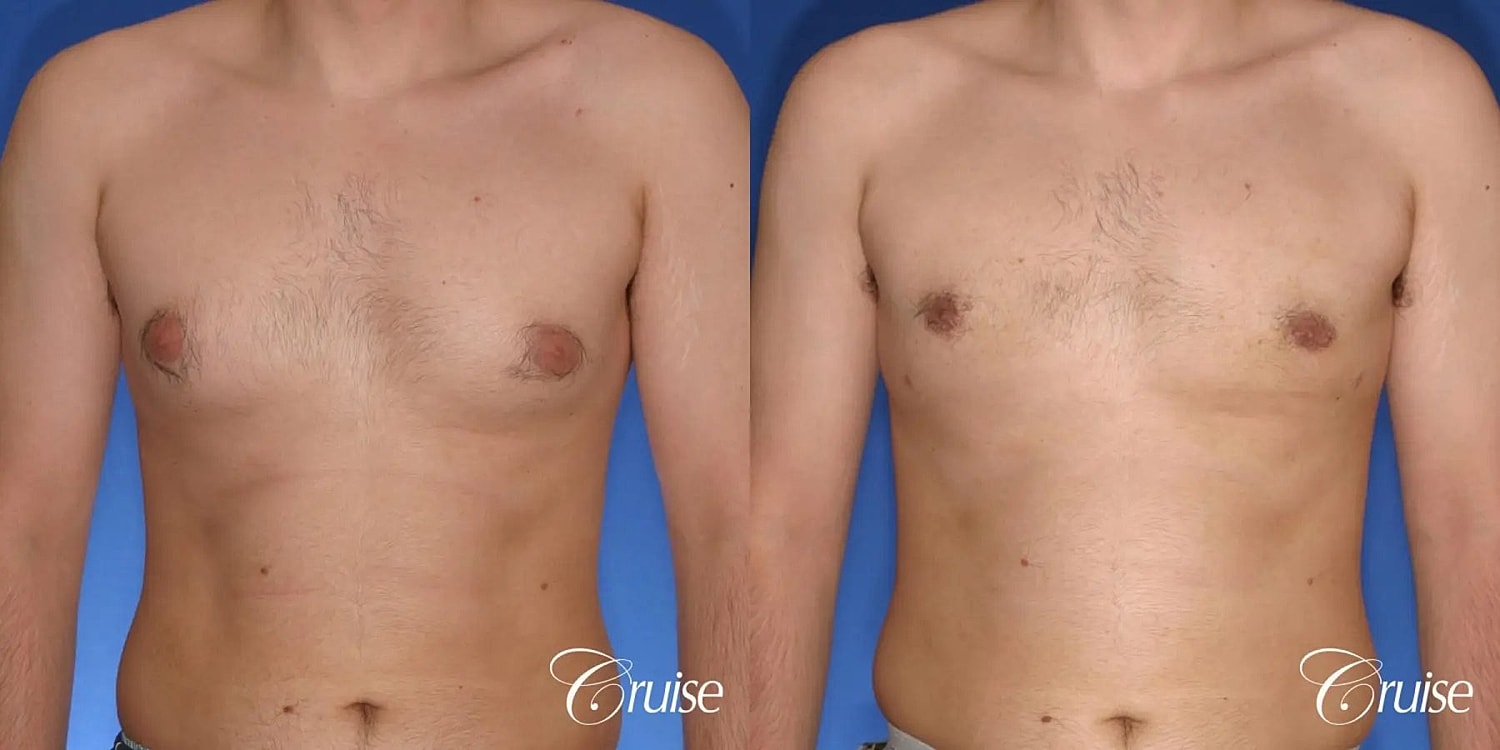 Gynecomastia Surgery Before & After