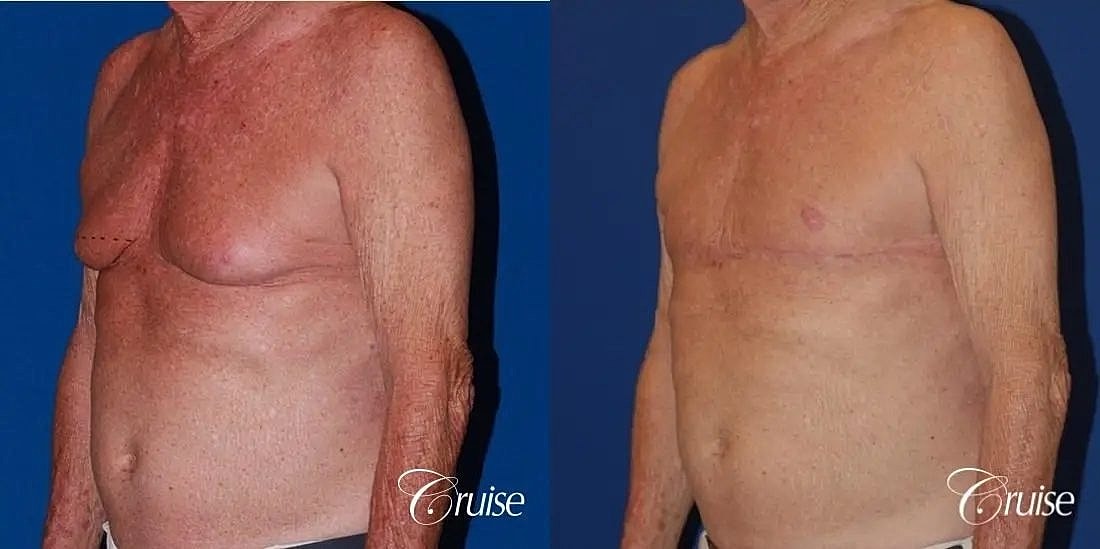 Gynecomastia Surgery Before & After