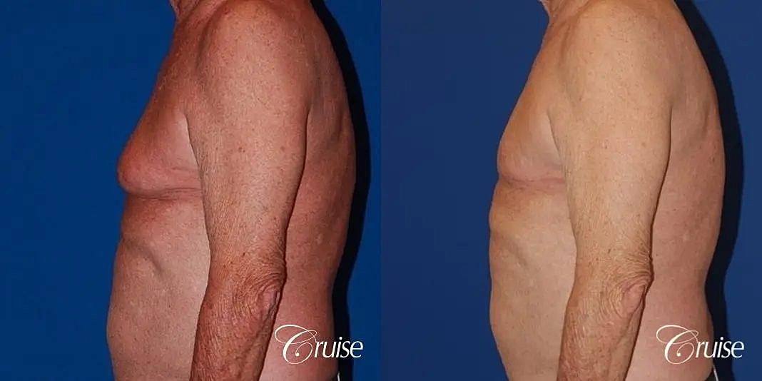 Gynecomastia Surgery Before & After