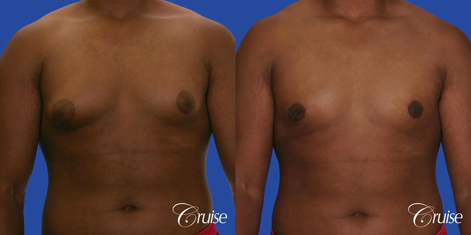 Gynecomastia Surgery Before & After