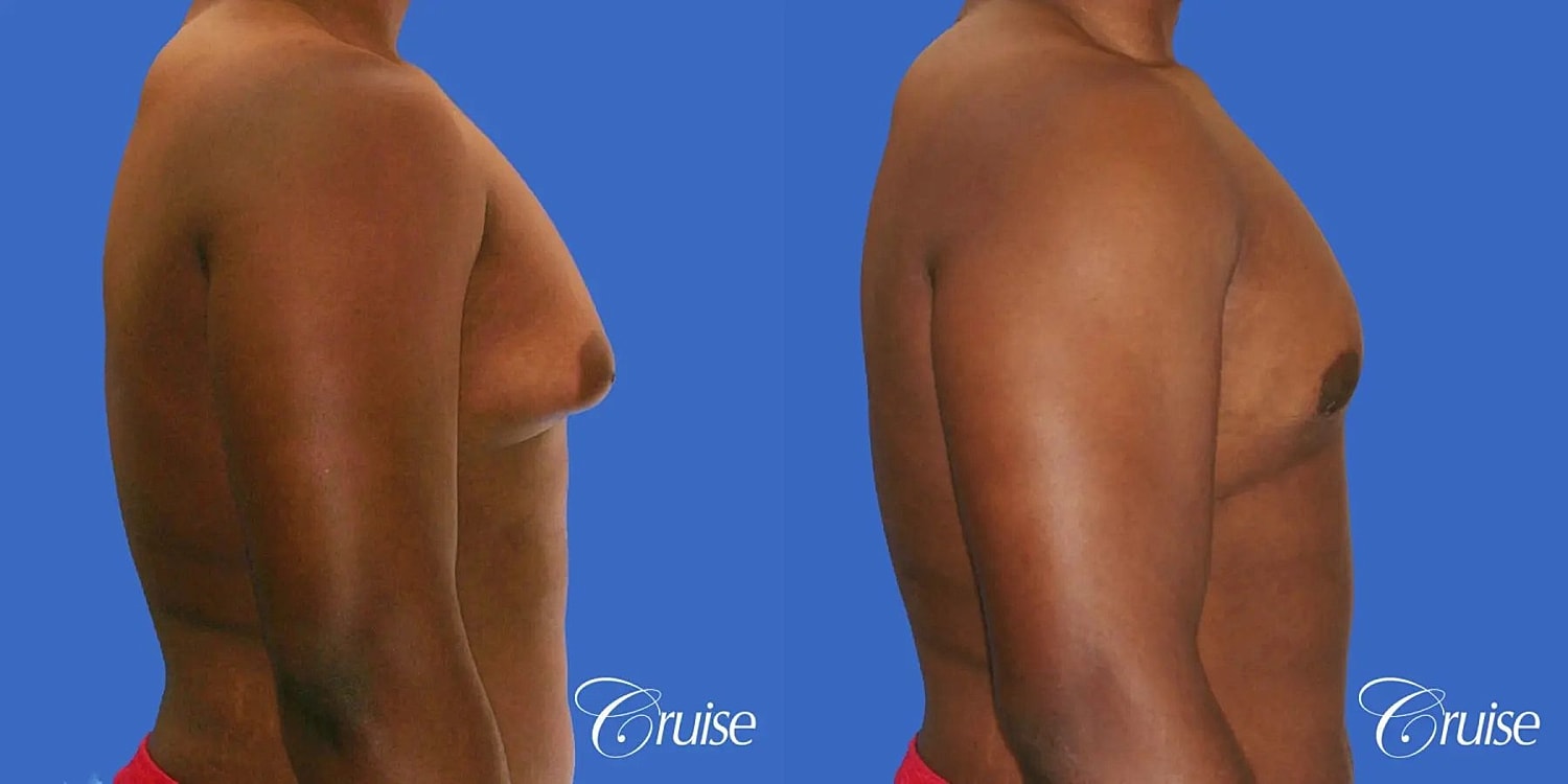 Gynecomastia Surgery Before & After
