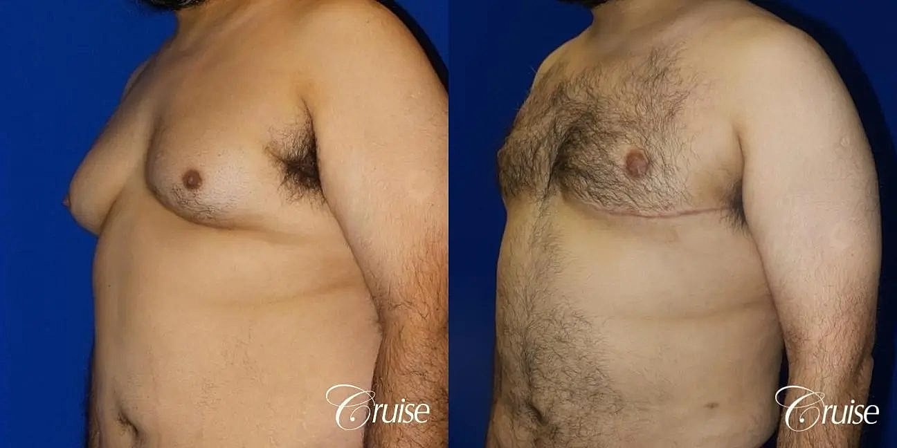 Gynecomastia Surgery Before & After