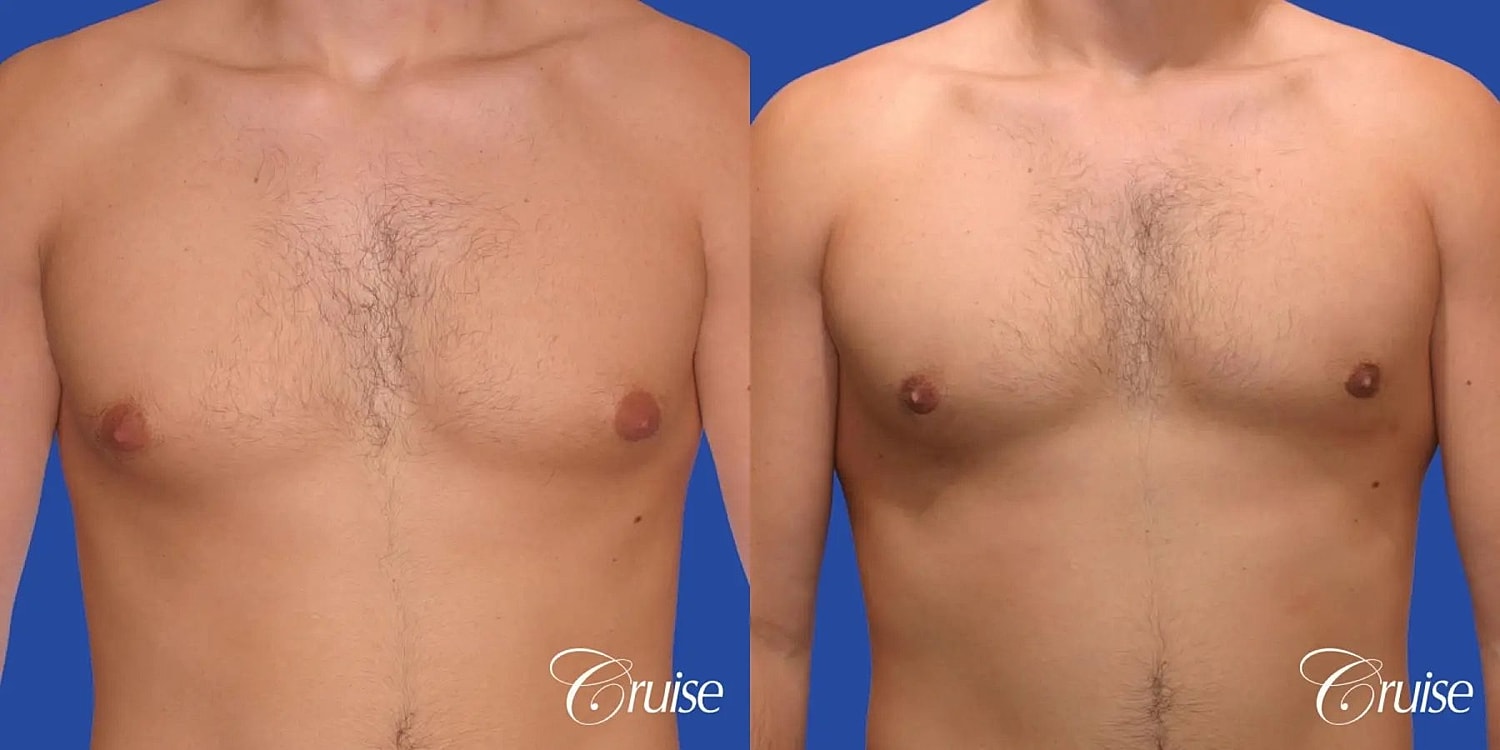 Gynecomastia Surgery Before & After