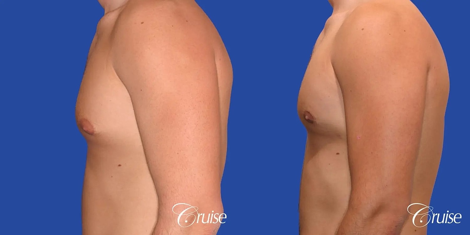 Gynecomastia Surgery Before & After