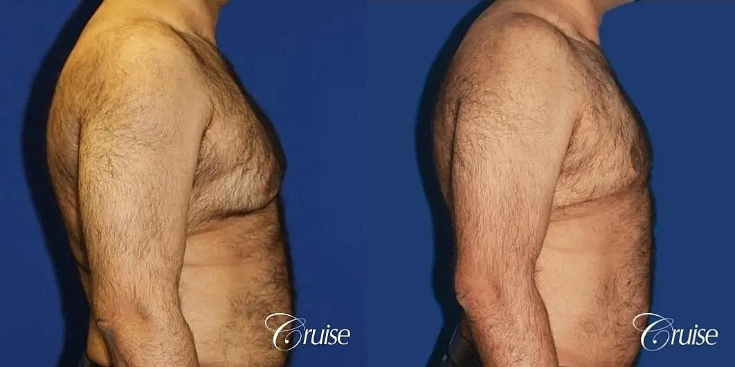 Gynecomastia Surgery Before & After