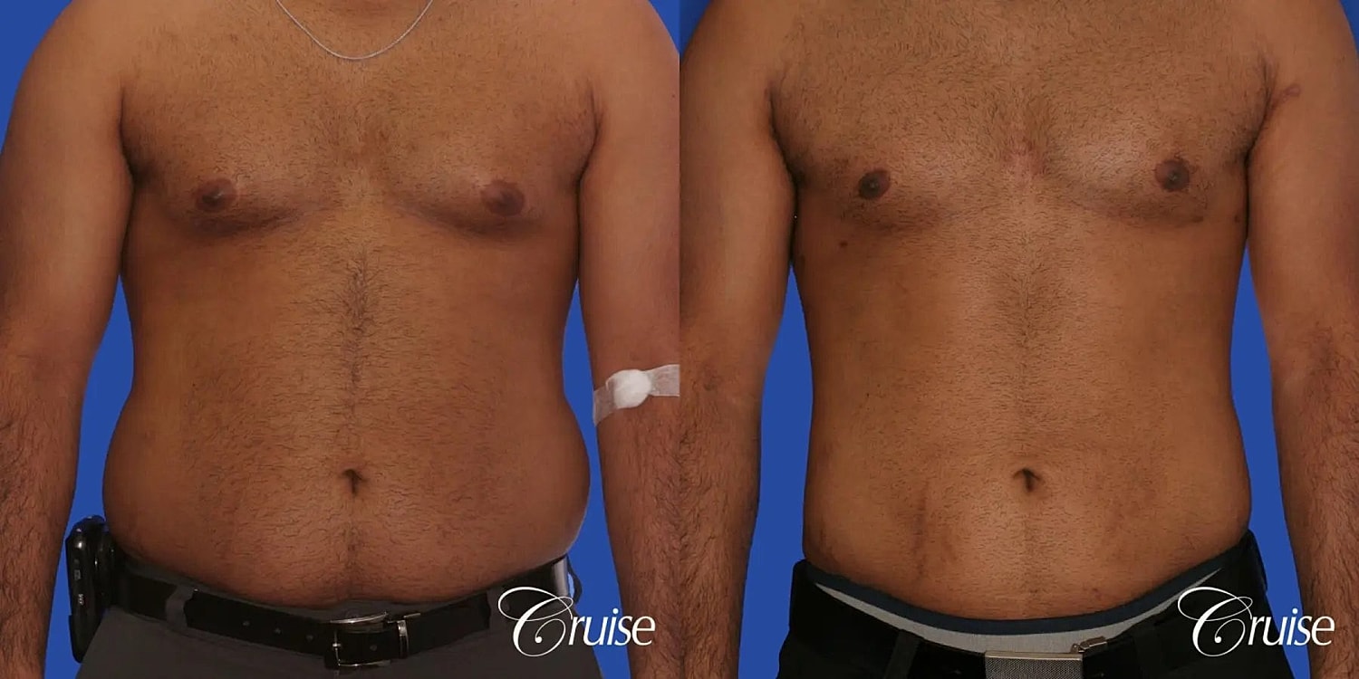 Gynecomastia Surgery Before & After
