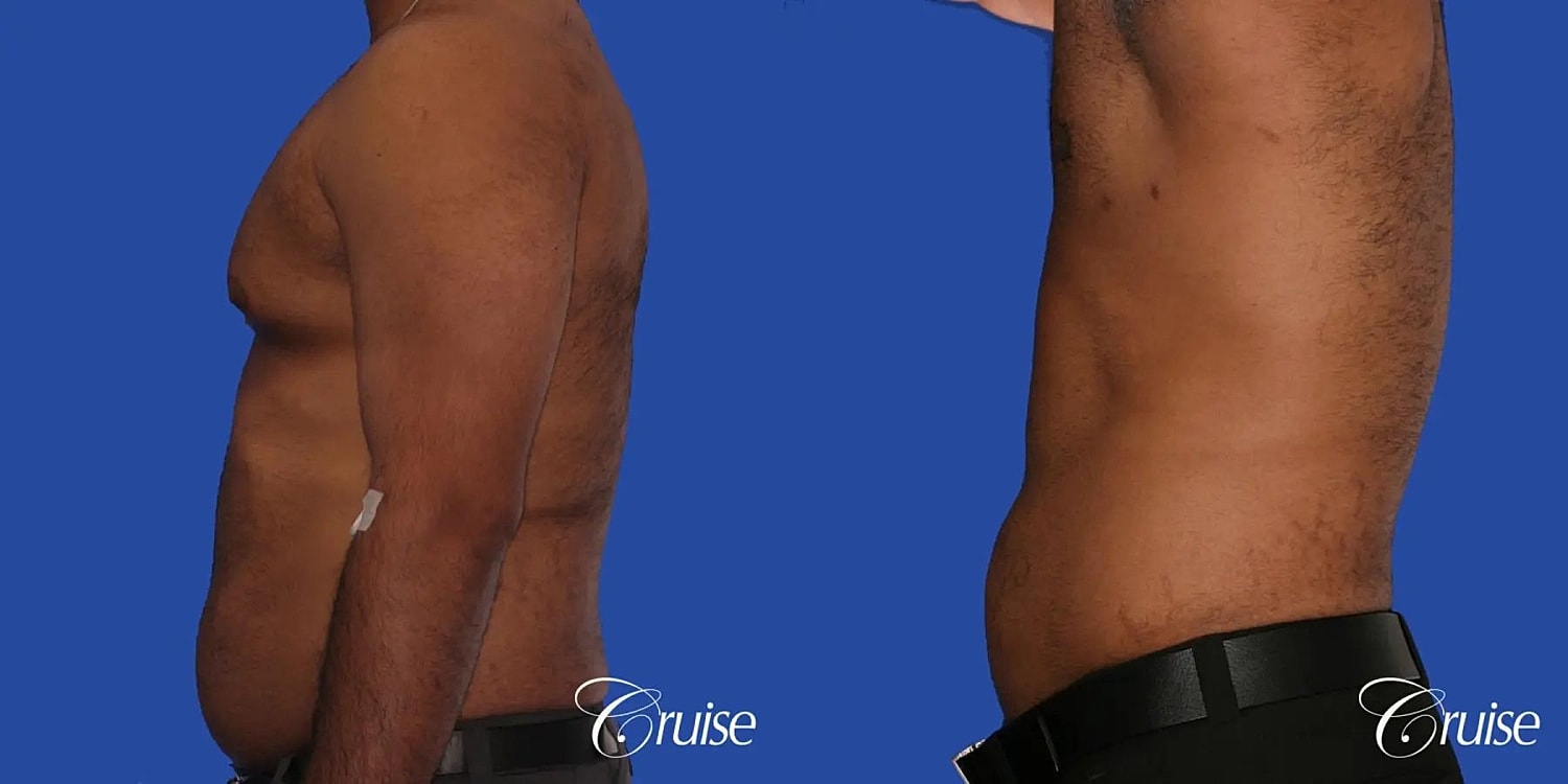 Gynecomastia Surgery Before & After