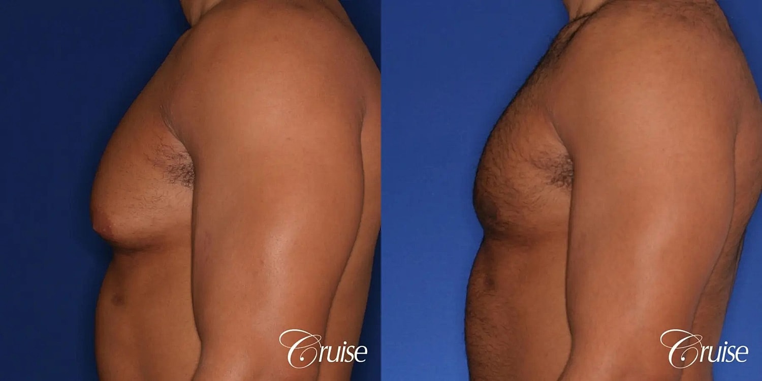 Gynecomastia Surgery Before & After