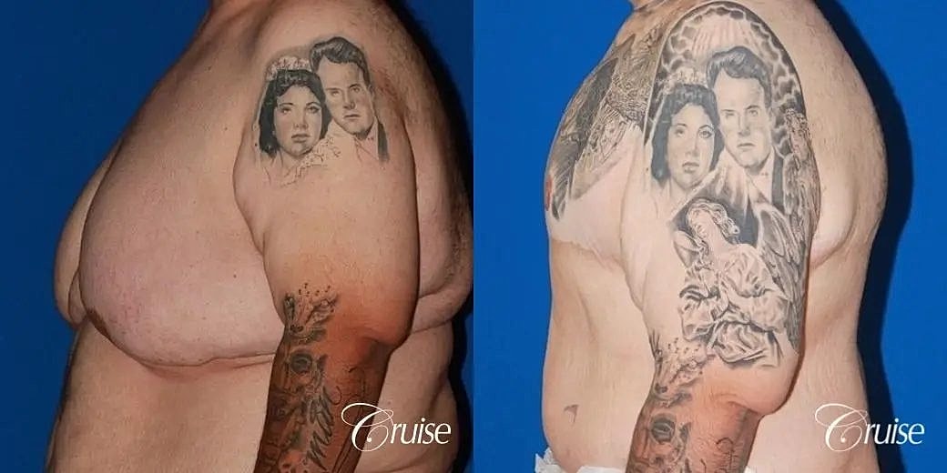 Gynecomastia Surgery Before & After