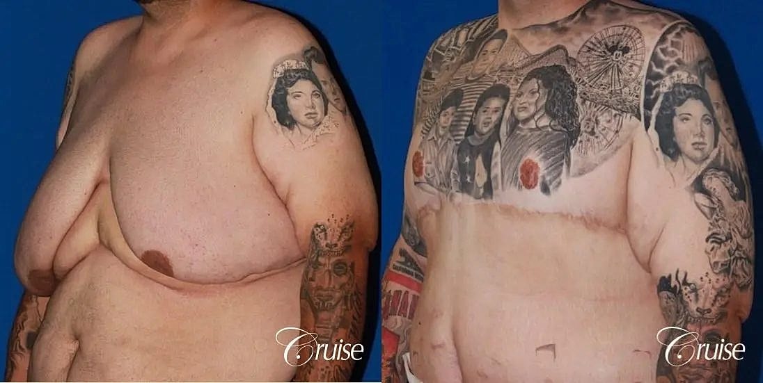 Gynecomastia Surgery Before & After