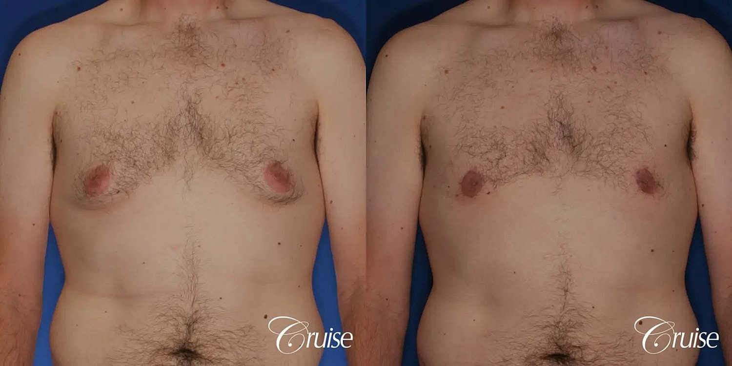 Gynecomastia Surgery Before & After