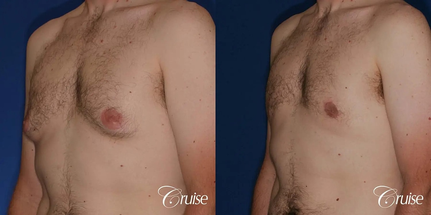 Gynecomastia Surgery Before & After