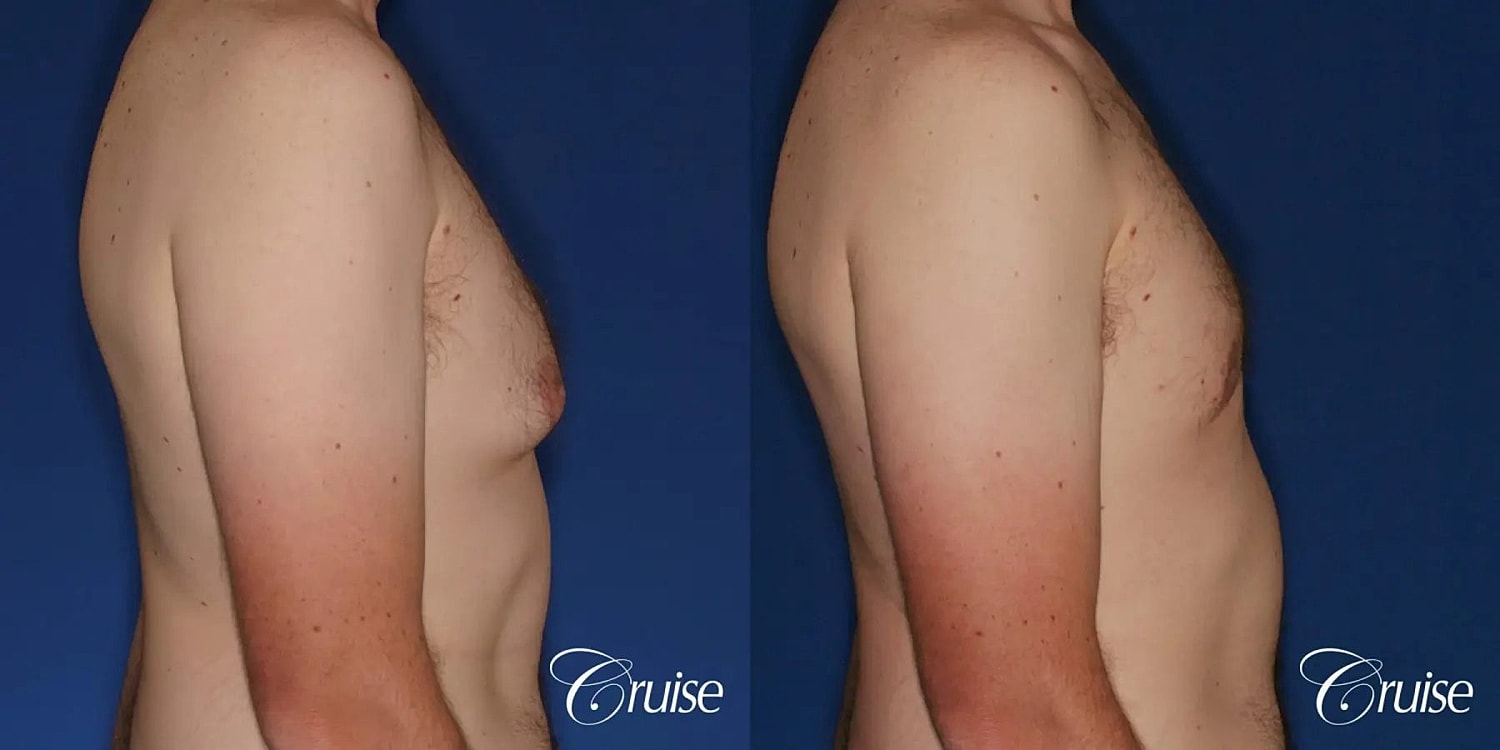 Gynecomastia Surgery Before & After