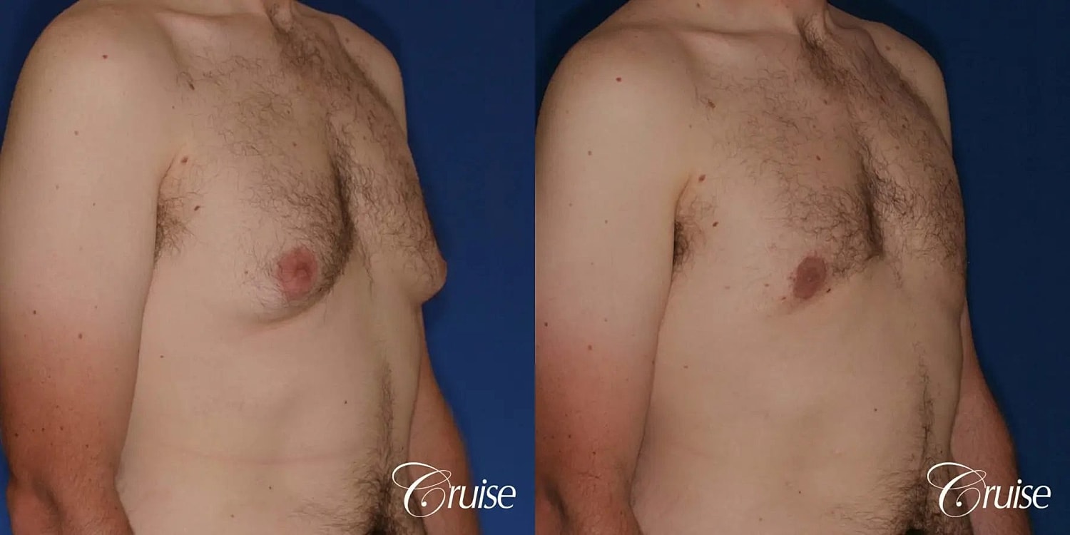 Gynecomastia Surgery Before & After