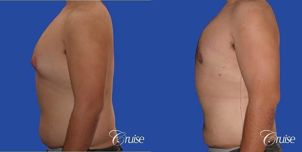 Gynecomastia Surgery Before & After