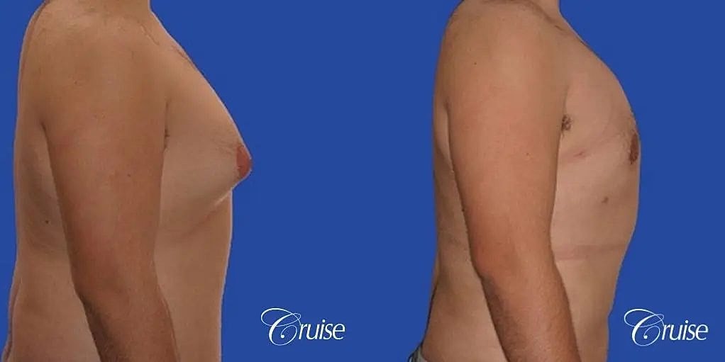 Gynecomastia Surgery Before & After