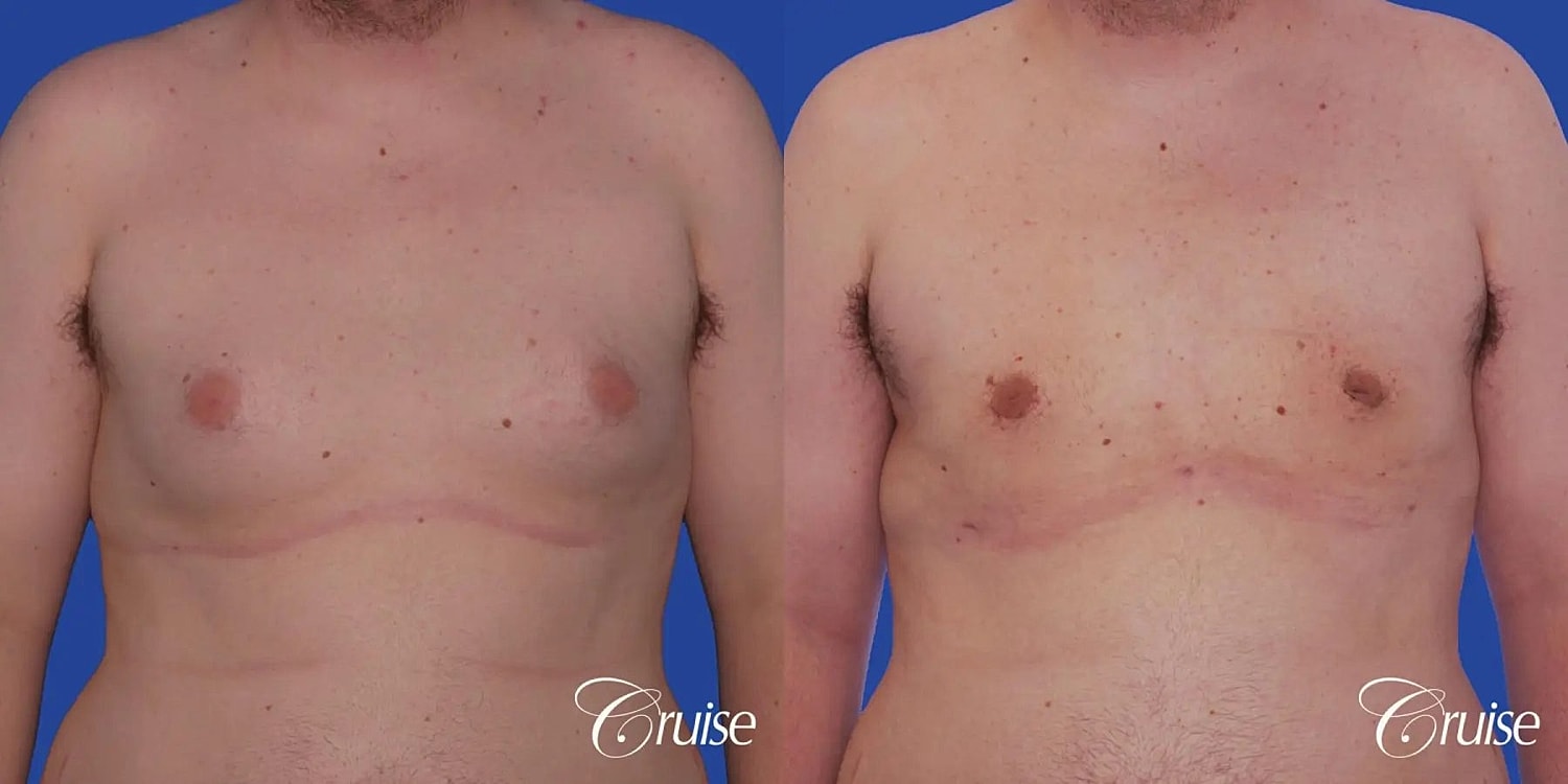 Gynecomastia Surgery Before & After