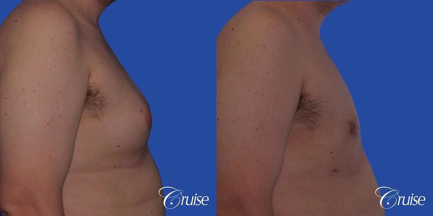 Gynecomastia Surgery Before & After