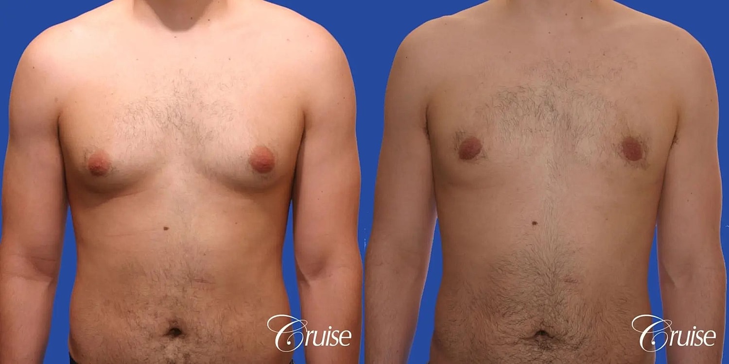 Gynecomastia Surgery Before & After