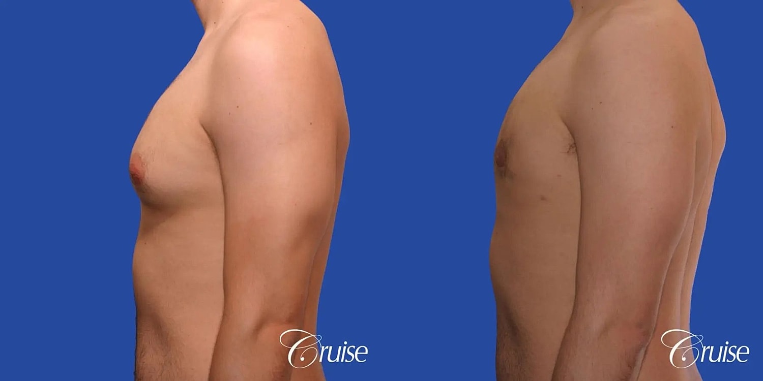 Gynecomastia Surgery Before & After