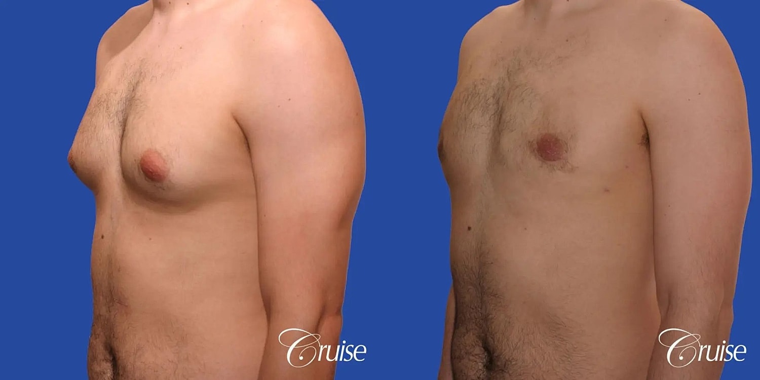 Gynecomastia Surgery Before & After