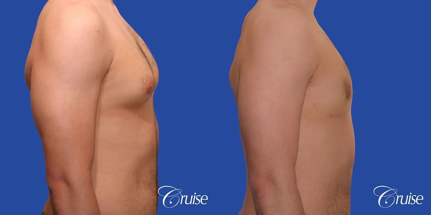 Gynecomastia Surgery Before & After