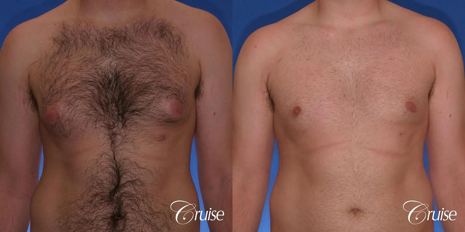 Gynecomastia Surgery Before & After