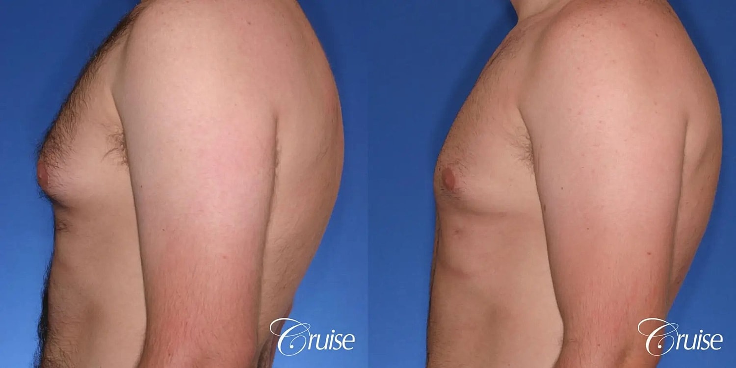 Gynecomastia Surgery Before & After
