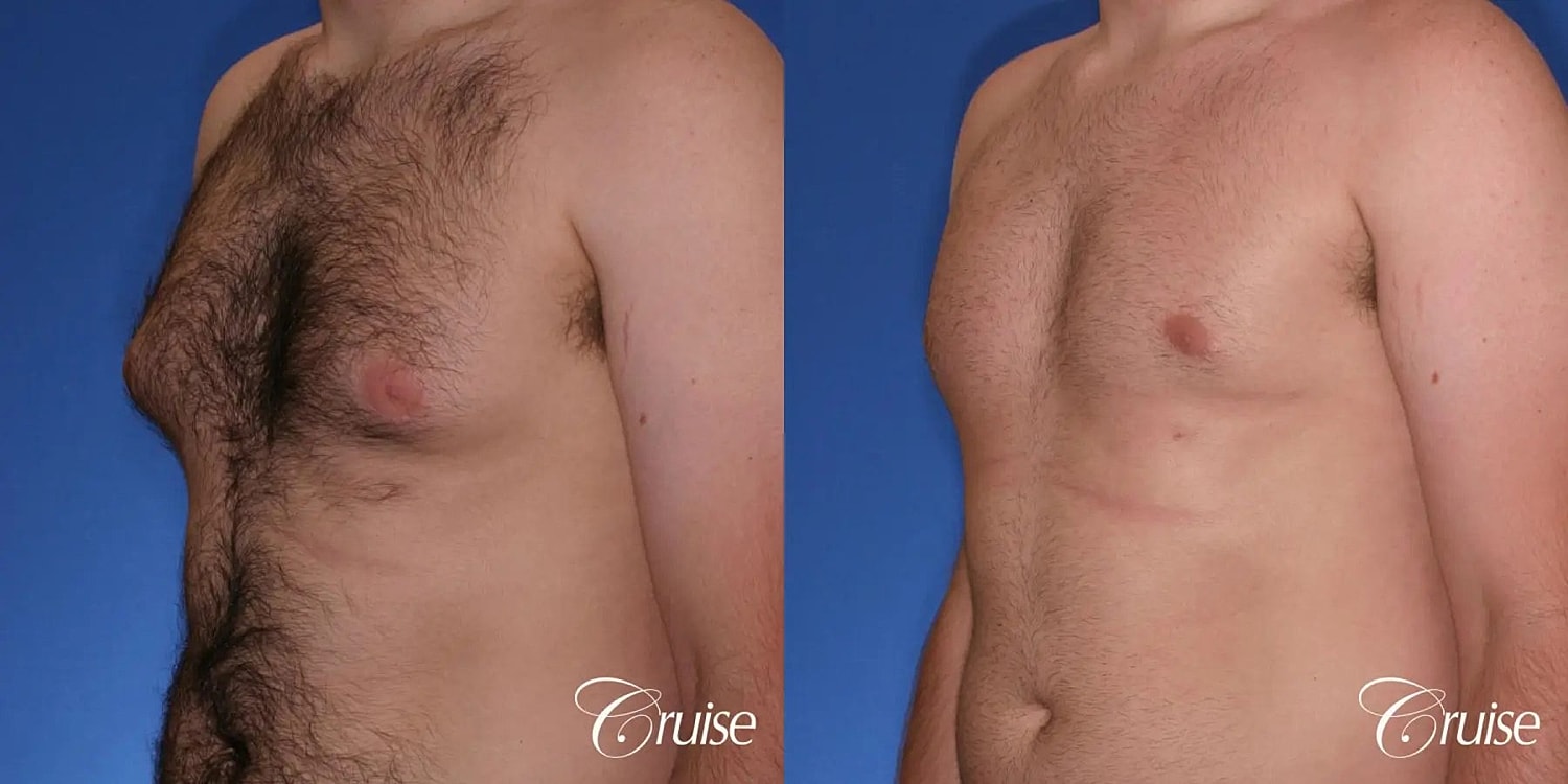 Gynecomastia Surgery Before & After