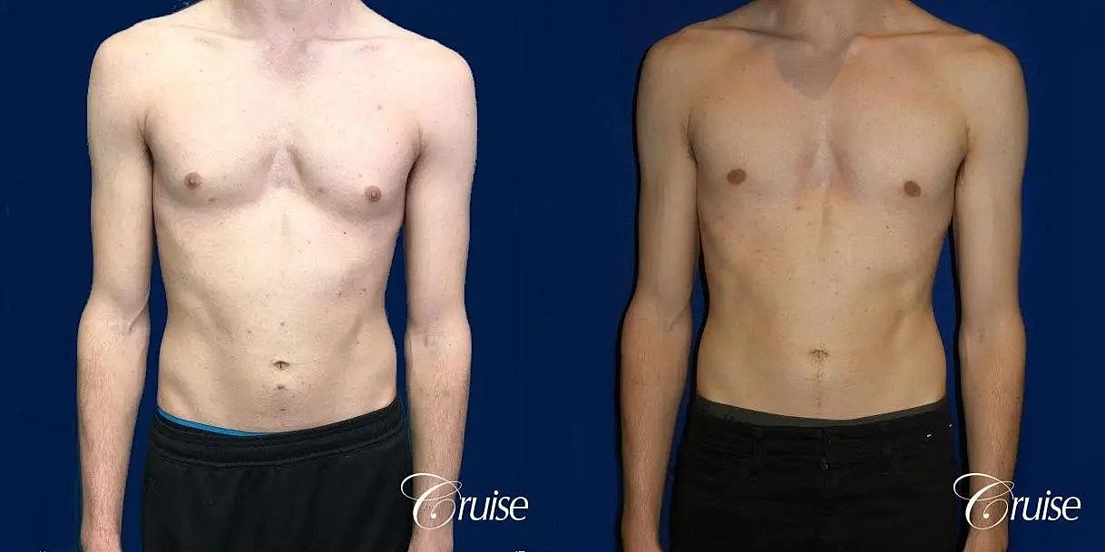 Gynecomastia Surgery Before & After