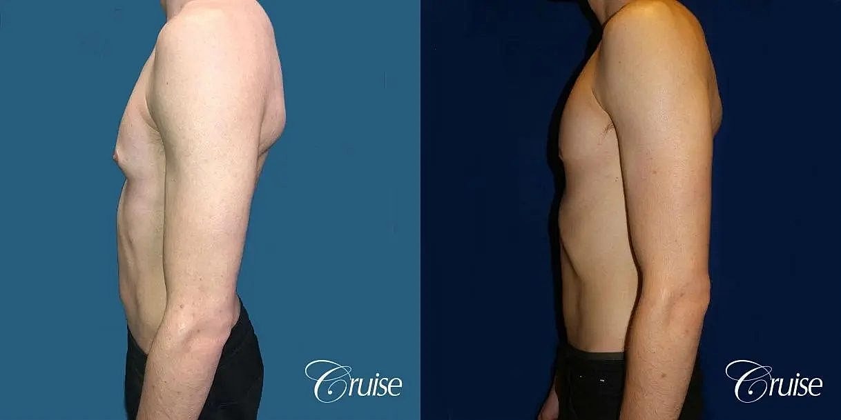 Gynecomastia Surgery Before & After