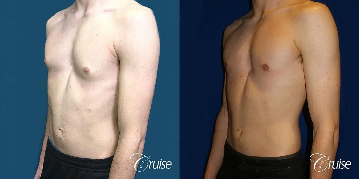 Gynecomastia Surgery Before & After
