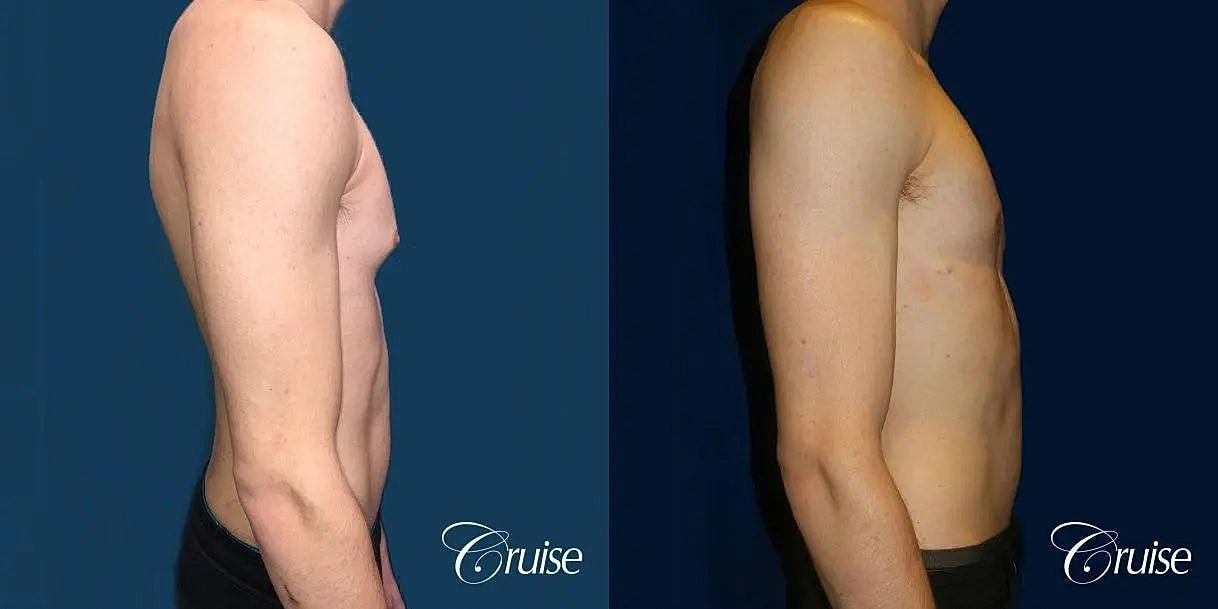 Gynecomastia Surgery Before & After