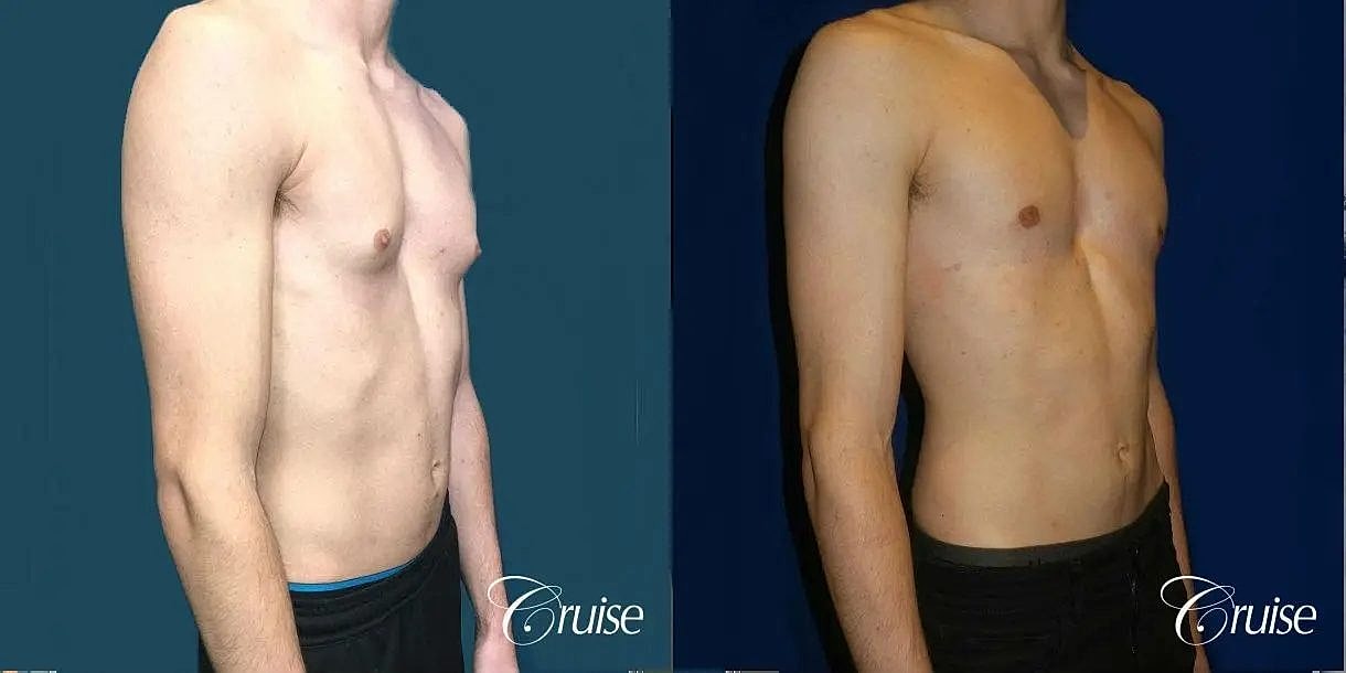 Gynecomastia Surgery Before & After